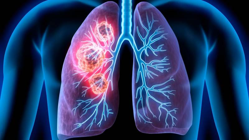 How to Reduce Your Risk of Lung Cancer: Expert Tips?